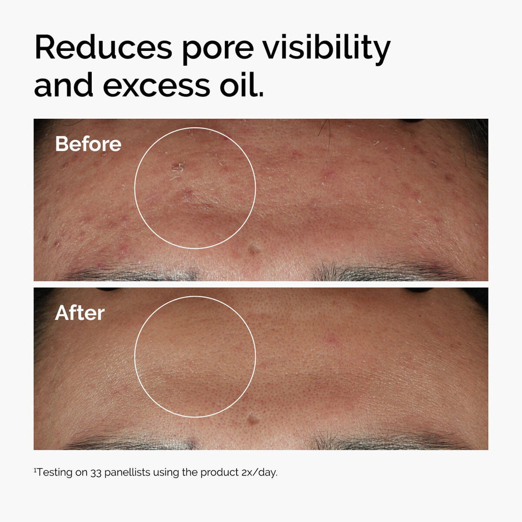niacinamide-10-zinc-1-h7 ord-niacinamide-zinc-blemish-serum-before-after-pores.jpg