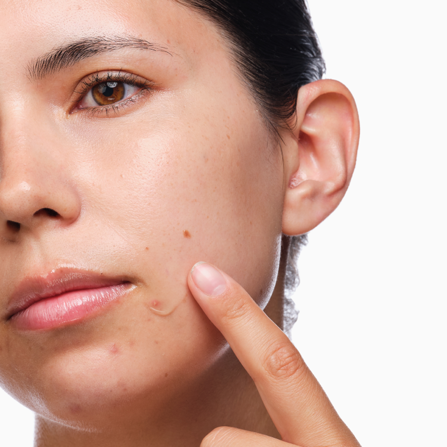the-acne-set-g9 rdn-the-acne-set-application.png